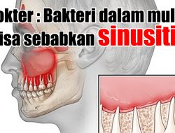 Dokter : Bakteri Dalam Mulut Bisa Sebabkan Sinusitis
