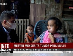 Mesyan Menderita Tumor pada Mulut, Desa Perjuangan Kecamatan Sei Balai | Info Bisanews