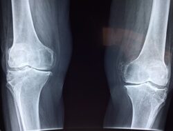 Catat, Lima Minuman Sehat Ini Kuatkan Tulang dan Cegah Osteoporosis